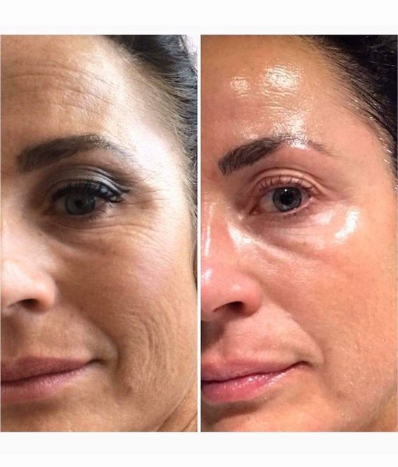 Microderm Treatment