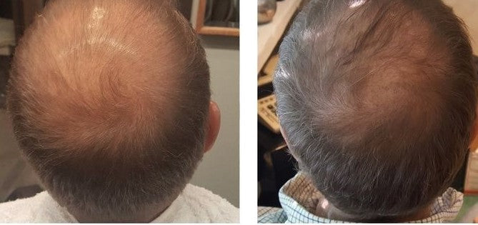 Advanced Hair Growth System