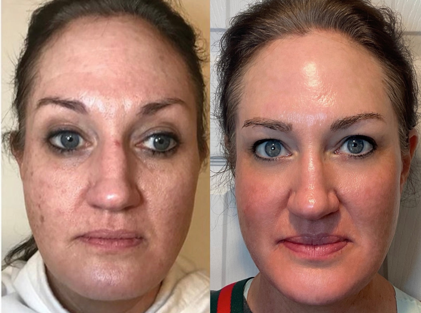 Microderm Treatment