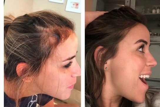 Advanced Hair Growth System